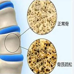 【骨密度分析儀科普】骨密度指標(biāo)對照表，人手一份