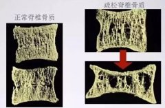 哪些人群需重點(diǎn)關(guān)注骨密度檢查，需及時(shí)補(bǔ)鈣