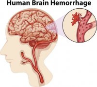 為什么我們的腦血管會(huì)出問(wèn)題?